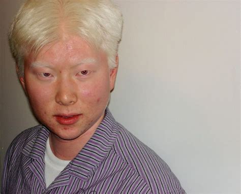 albino feio|Albinism in humans